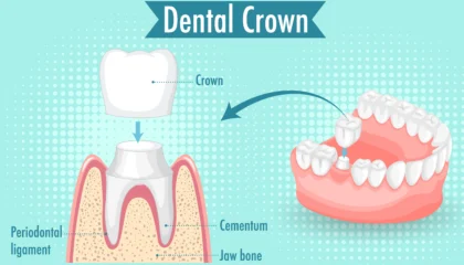 Why Do I Need a Crown on My Tooth? A Complete Guide to Dental Crowns
