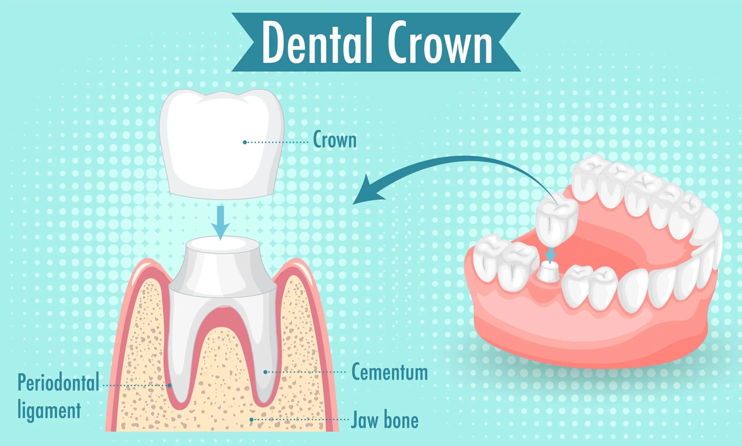 Why Do I Need a Crown on My Tooth? A Complete Guide to Dental Crowns