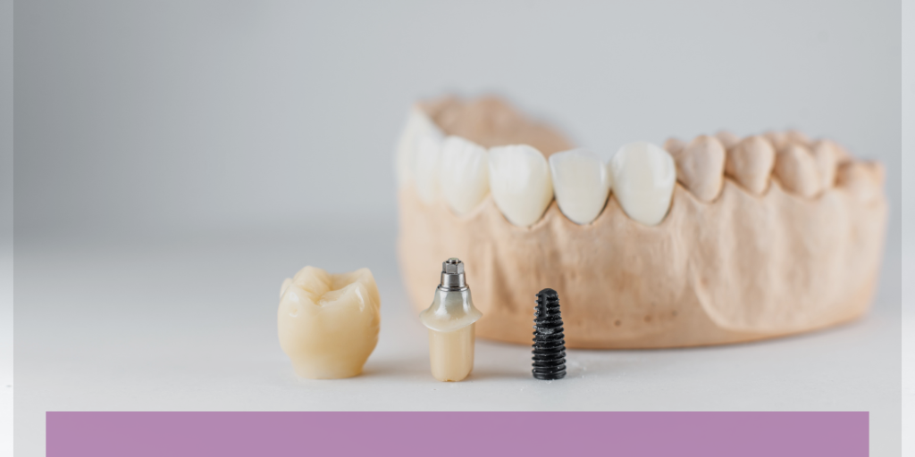 Dental implant parts including the crown, abutment, and titanium post next to a jaw model.