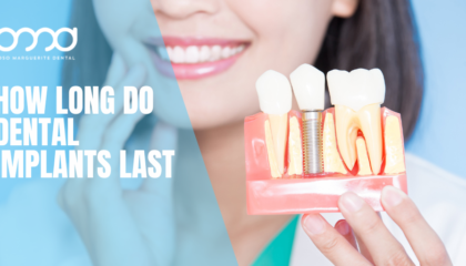 Dentist holding a dental implant model, illustrating how long dental implants last