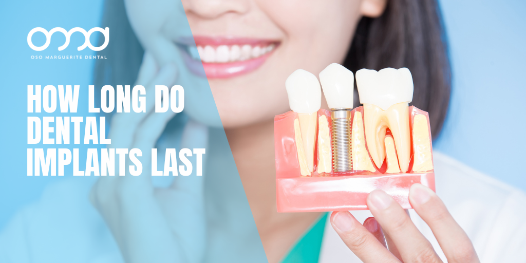 Dentist holding a dental implant model, illustrating how long dental implants last