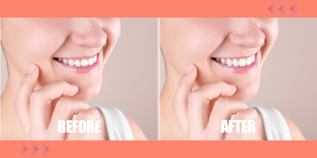 Before and after comparison of a woman's smile following a gum lift