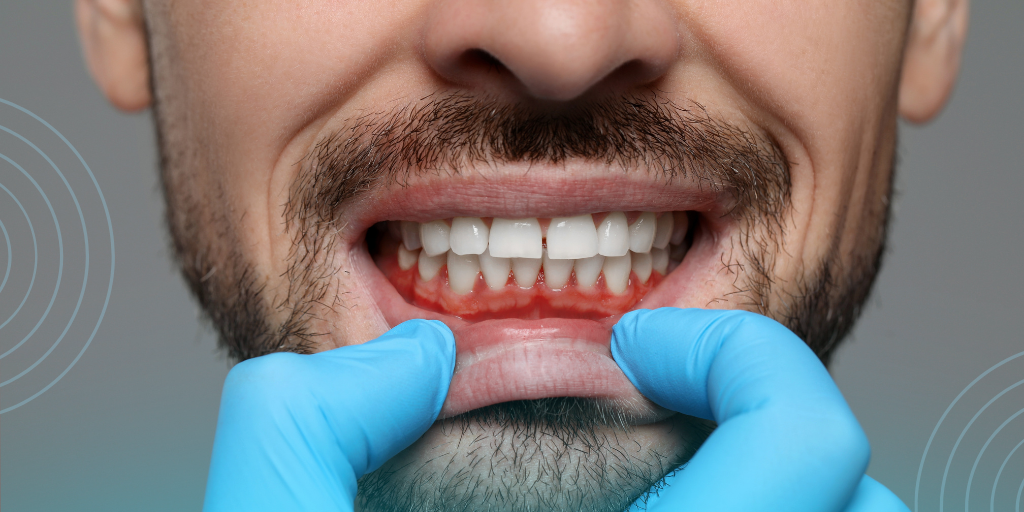 Gloved hands revealing a man's red, inflamed gums with signs of gum disease