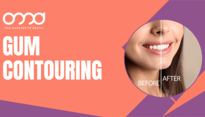 Split view showing a smile before and after gum contouring