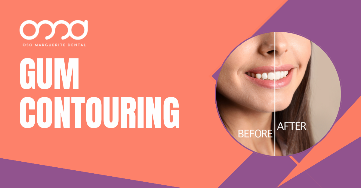 Split view showing a smile before and after gum contouring