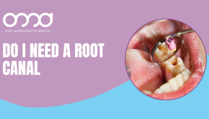Dentist using a mirror to examine a decayed tooth before root canal treatment