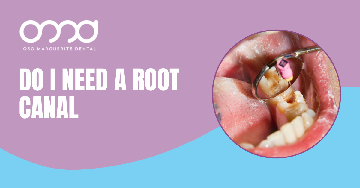 Dentist using a mirror to examine a decayed tooth before root canal treatment